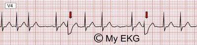 Electrocardiograma de Fenómeno de Ashman