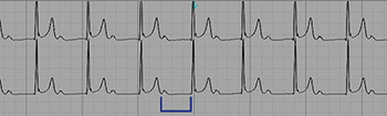 Electrocardiograma de Bloqueo Auriculoventricular de Primer Grado