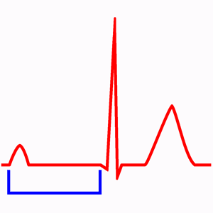 Bloqueo Auriculoventricular (Bloqueo AV) de Primer Grado