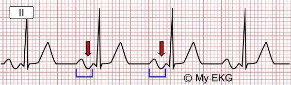 Electrocardiograma de Bloqueo Interauricular Avanzado