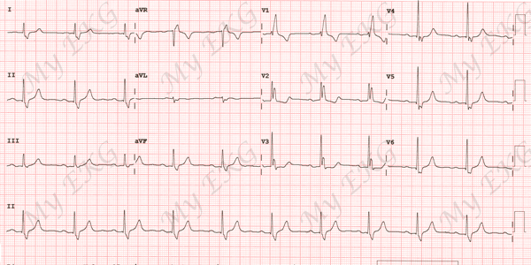Bloqueo completo de Rama Derecha en el Electrocardiograma