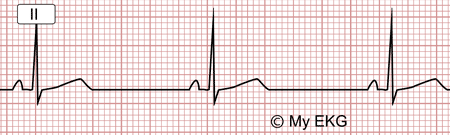 Electrocardiograma de Bradicardia Sinusal