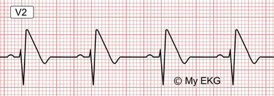 Electrocardiograma de Patrón de Brugada tipo 1