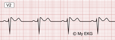 Electrocardiograma de Patrón de Brugada tipo 2