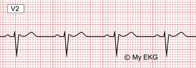 Electrocardiograma de Patrón de Brugada tipo 3