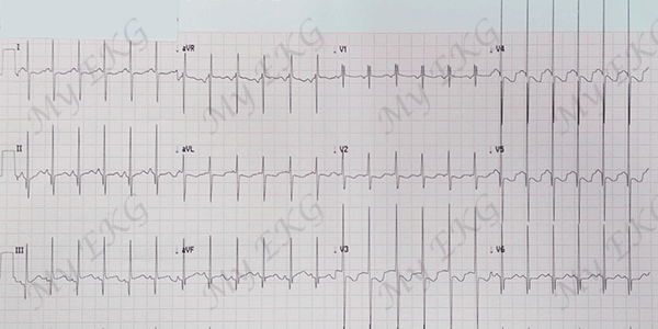 Electrocardiograma de Comunicación Interventricular grande