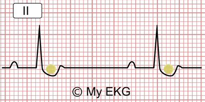 Cubeta digitálica en el Electrocardiograma