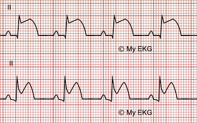 Diferencias entre EKG de IAMCEST y de Pericarditis