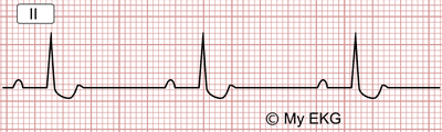 Cambios en el Electrocardiograma por Digoxina