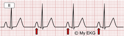 Electrocardiograma del Crecimiento Auricular Derecho