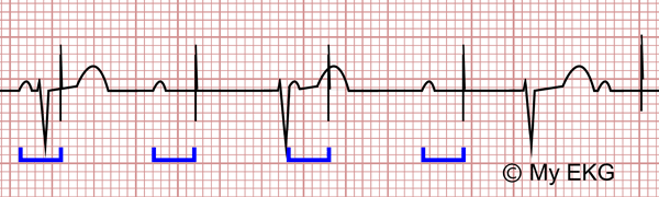 Disfunción de Marcapasos en el Electrocardiograma, Fallo de Captura