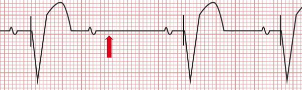 Disfunción de Marcapasos en el Electrocardiograma, Ausencia de espículas