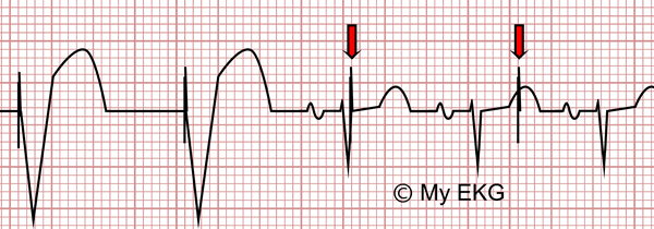 Disfunción de Marcapasos en el Electrocardiograma, Infrasensado
