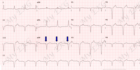 EKG con Estimulación Ventricular por Marcapasos