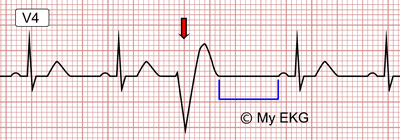 Extrasístole Ventricular en un Electrocardiograma
