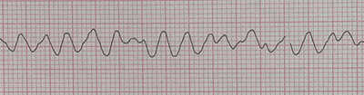 Fibrilación Ventricular en el Electrocardiograma