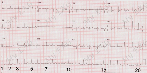 Calcular a Frequência Cardíaca no Eletrocardiograma no ritmo iregular