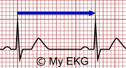 Cálculo de Frecuencia Cardiaca por distancia del intervalo RR