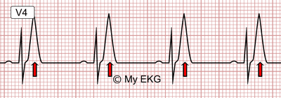 Electrocardiograma de Hiperpotasemia Leve