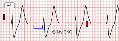 Electrocardiograma de Hiperpotasemia Moderada