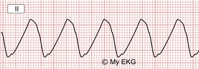 Electrocardiograma de Hiperpotasemia Severa