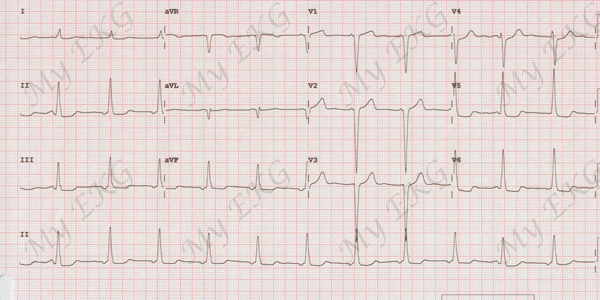 Hipertrofia Ventricular Izquierda en el EKG