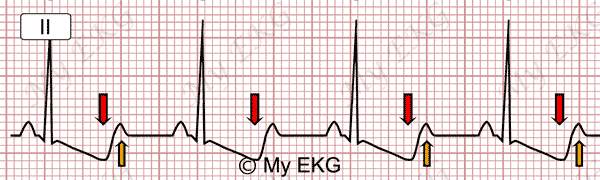 Electrocardiograma de Hipopotasemia Severa