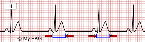 Electrocardiograma de Hipercalcemia