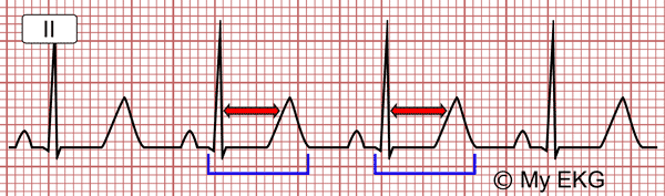 Electrocardiograma de la Hipocalcemia
