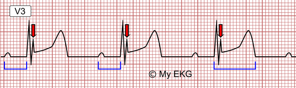 Electrocardiograma de Hipotermia leve