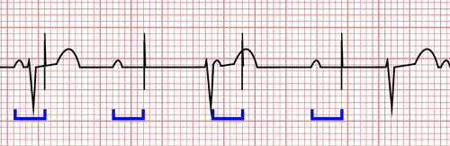 Alteraciones del Marcapasos en el Electrocardiograma