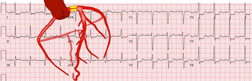 Electrocardiogramas Difíciles de Infarto Agudo