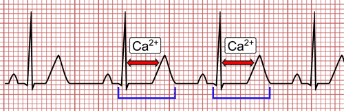 Hipocalcemia en el EKG