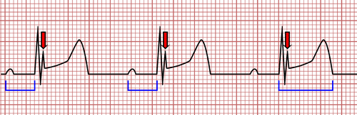 EKG e Hipotermia