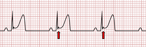 Repolarización Precoz en el EKG