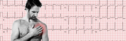 Electrocardiograma de Síndrome Coronario Agudo