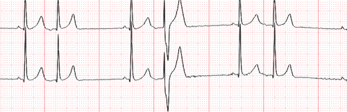 Fenómeno de Ashman en el Electrocardiograma