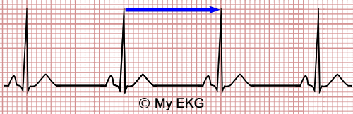 Calculadora de Frecuencia Cardiaca en el Electrocardiograma