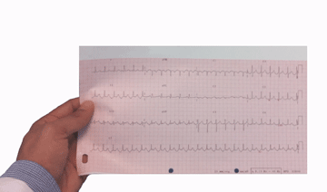 Cómo Realizar un Electrocardiograma
