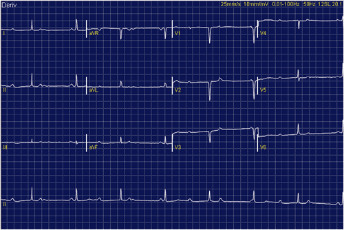 Electrocardiograma de Examen MIR 2012