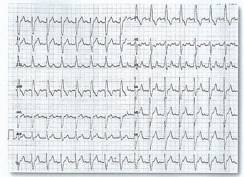 Electrocardiograma de Examen MIR 2014
