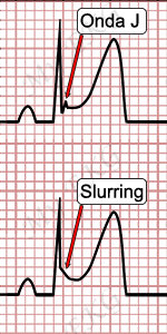 Onda J y Slurring, Electrocardiograma de Repolarización Precoz