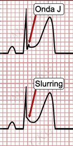 Onda J, Electrocardiograma de Repolarización Precoz