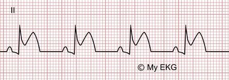 Electrocardiograma de Pericarditis aguda, fase 1