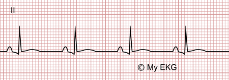Electrocardiograma de Pericarditis aguda, fase 2