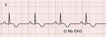 Electrocardiograma de Pericarditis aguda, fase 3