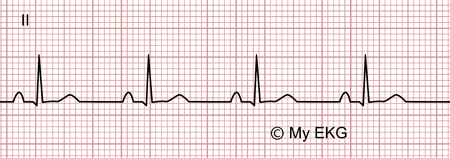 Electrocardiograma de Pericarditis aguda, fase 4