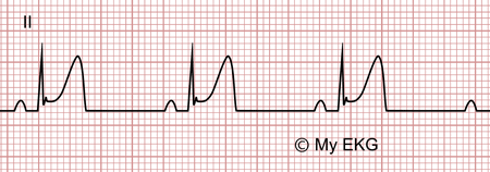 Electrocardiograma de Repolarización Precoz