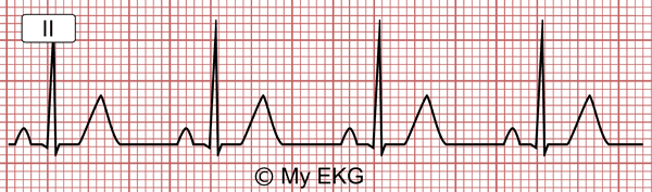 Ritmo Sinusal Normal en el Electrocardiograma