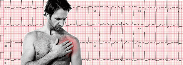 Síndromes Coronarios Agudos en el Electrocardiograma